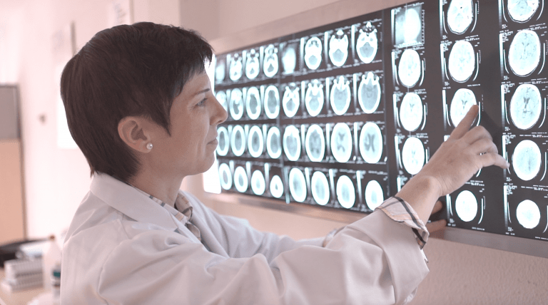 El ictus es la principal causa de epilepsia en adultos